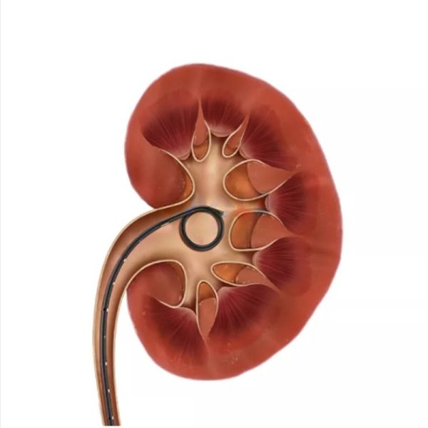 Cateter Duplo J de Longa Permanência